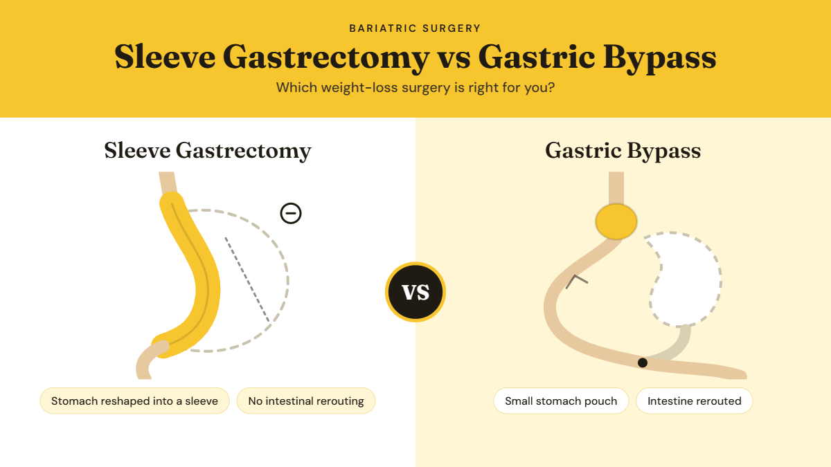 Infographic comparing sleeve gastrectomy, where the stomach is reshaped into a narrow sleeve with no intestinal rerouting, and gastric bypass, where a small stomach pouch is created and the intestine is rerouted